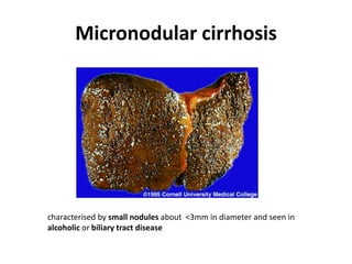Micronodular cirrhosis

characterised by small nodules about <3mm in diameter and seen in
alcoholic or biliary tract disease

 