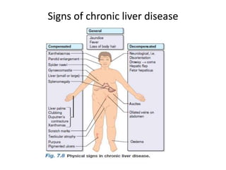 Signs of chronic liver disease

 