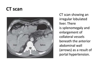 CT scan
CT scan showing an
irregular lobulated
liver. There
is splenomegaly and
enlargement of
collateral vessels
beneath the anterior
abdominal wall
(arrows) as a result of
portal hypertension.

 