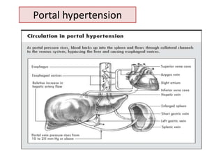 Portal hypertension

 
