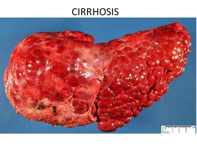 Primary Biliary Cirrhosis Natural Treatments Primary Biliary Cirrhosis Natural Treatments