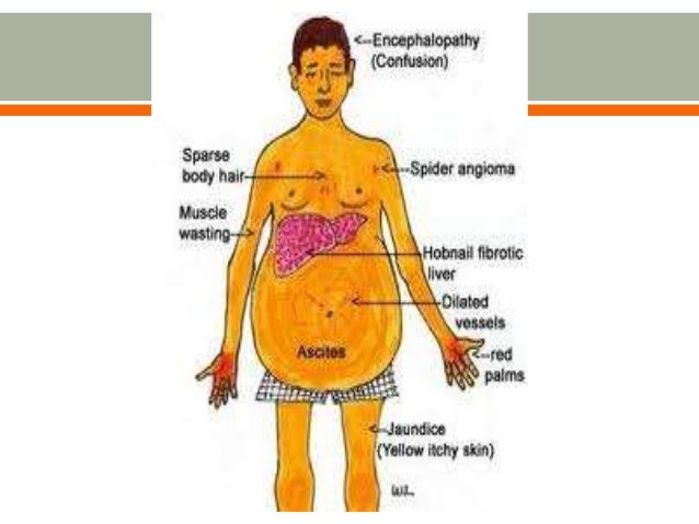 cirrhosis