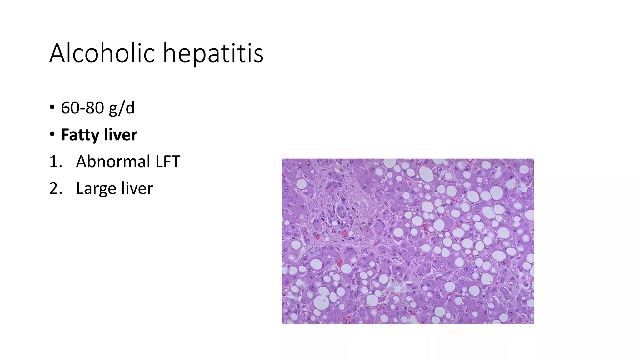 Alcoholic hepatitis
• 60-80 g/d
• Fatty liver
1. Abnormal LFT
2. Large liver
 