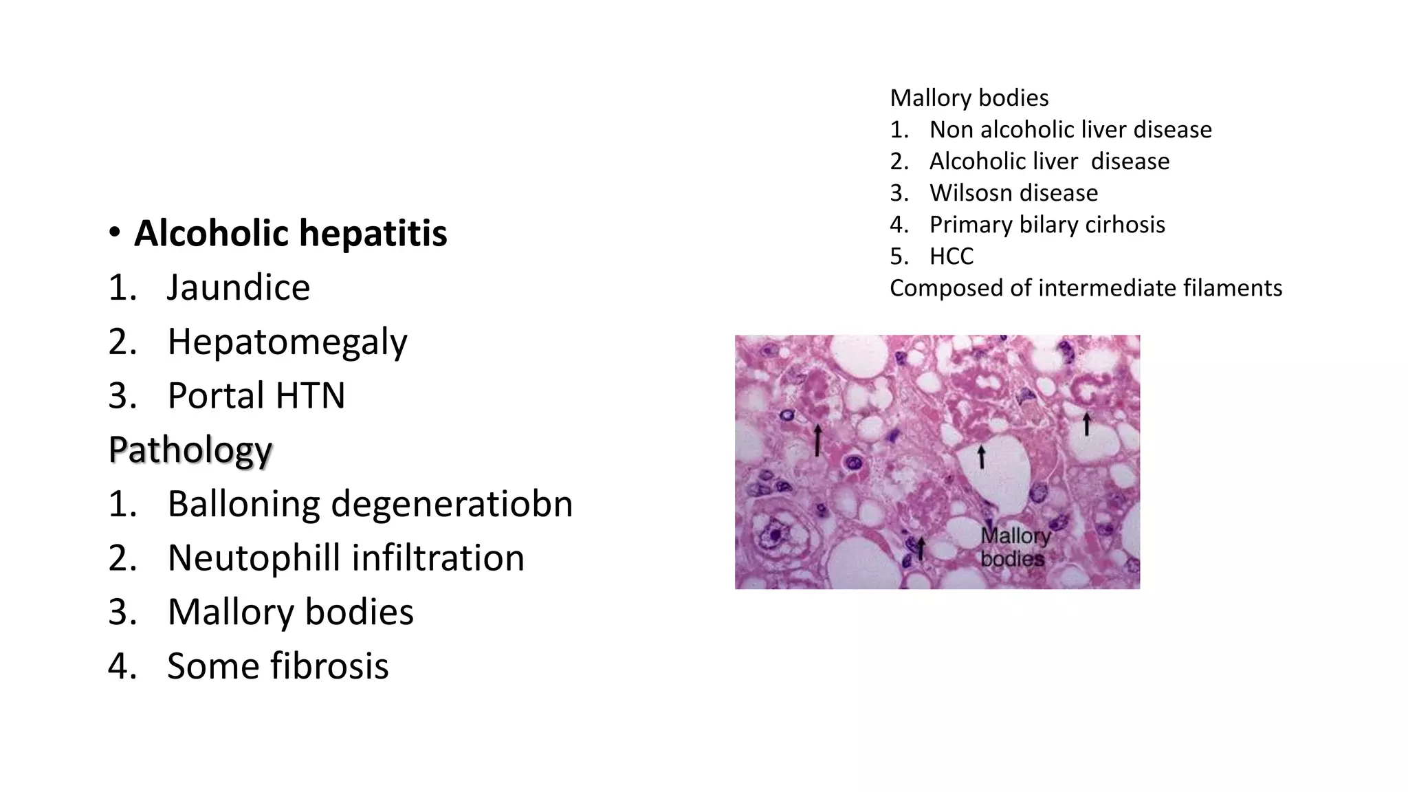 • Alcoholic hepatitis
1. Jaundice
2. Hepatomegaly
3. Portal HTN
Pathology
1. Balloning degeneratiobn
2. Neutophill infiltration
3. Mallory bodies
4. Some fibrosis
Mallory bodies
1. Non alcoholic liver disease
2. Alcoholic liver disease
3. Wilsosn disease
4. Primary bilary cirhosis
5. HCC
Composed of intermediate filaments
 