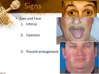 Signs 
• Eyes and Face 
1. Icterus 
2. Cyanosis 
3. Parotid enlargement 
 
