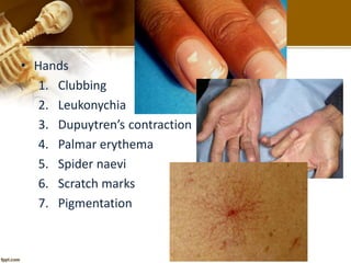 • Hands 
1. Clubbing 
2. Leukonychia 
3. Dupuytren’s contraction 
4. Palmar erythema 
5. Spider naevi 
6. Scratch marks 
7. Pigmentation 
 