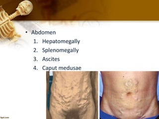 • Abdomen 
1. Hepatomegally 
2. Splenomegally 
3. Ascites 
4. Caput medusae 
 