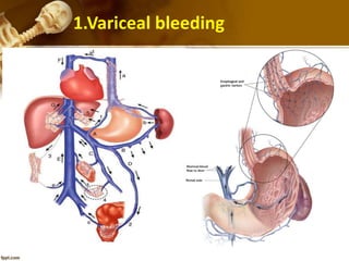 1.Variceal bleeding 
 