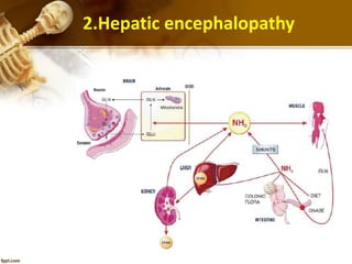 2.Hepatic encephalopathy 
 