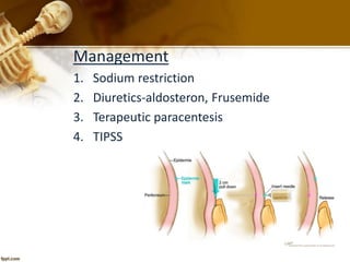 Management 
1. Sodium restriction 
2. Diuretics-aldosteron, Frusemide 
3. Terapeutic paracentesis 
4. TIPSS 
 
