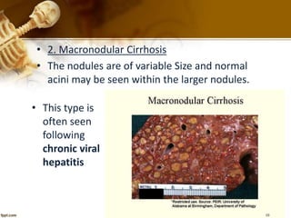 • 2. Macronodular Cirrhosis 
• The nodules are of variable Size and normal 
acini may be seen within the larger nodules. 
• This type is 
often seen 
following 
chronic viral 
hepatitis 
 