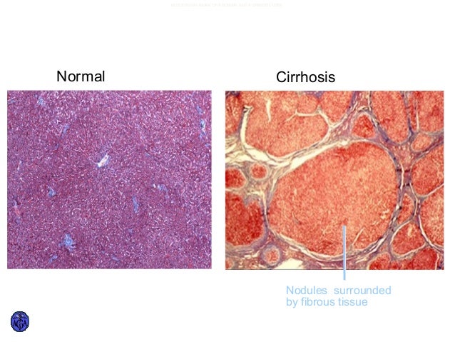 Cirrhosis of liver