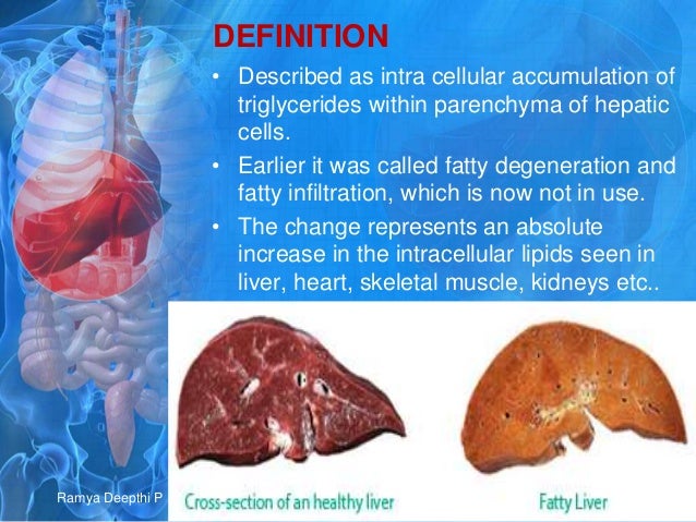 Cirrhosis of liver