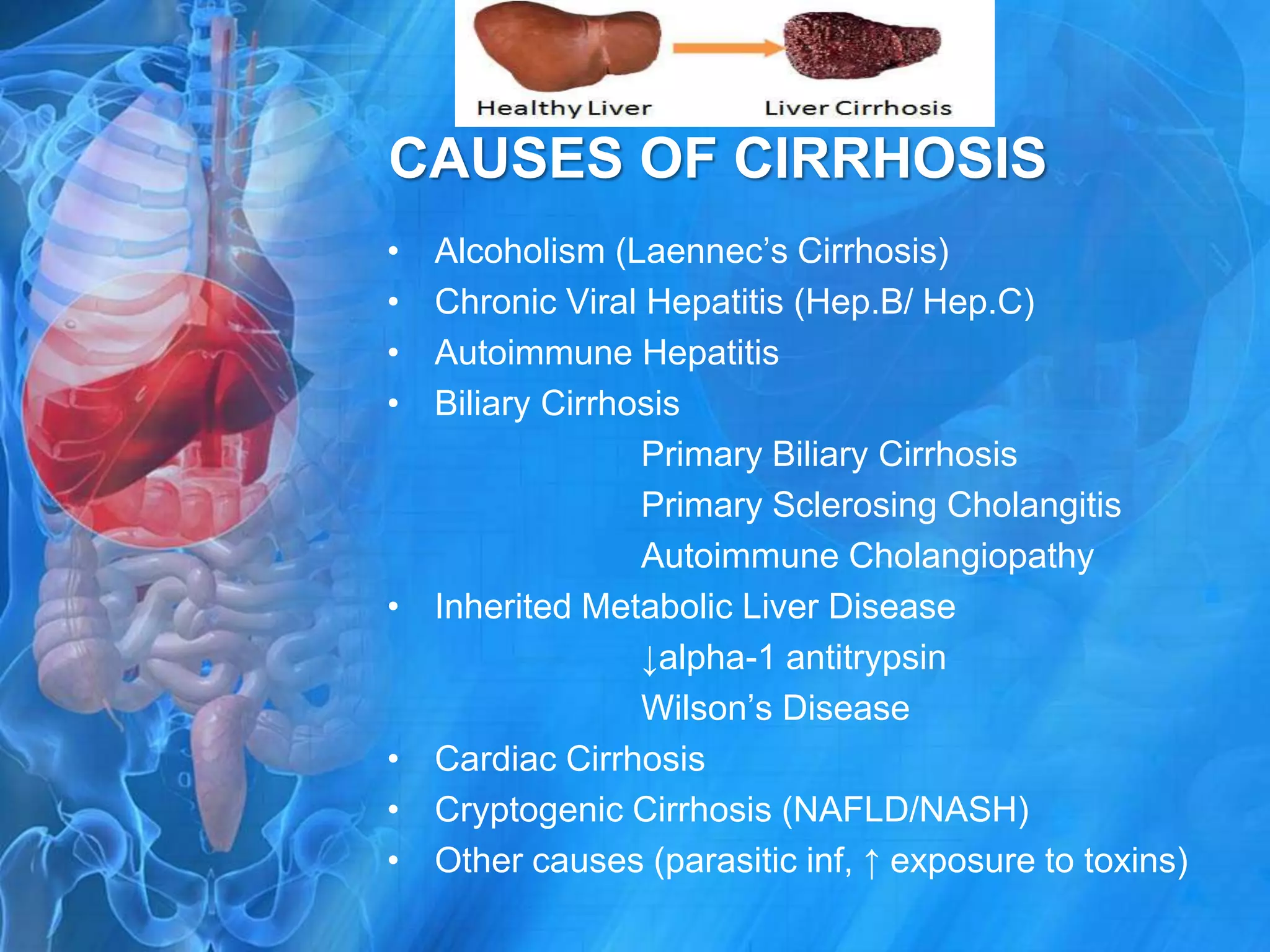 cirrhosis-of-liver-pptx