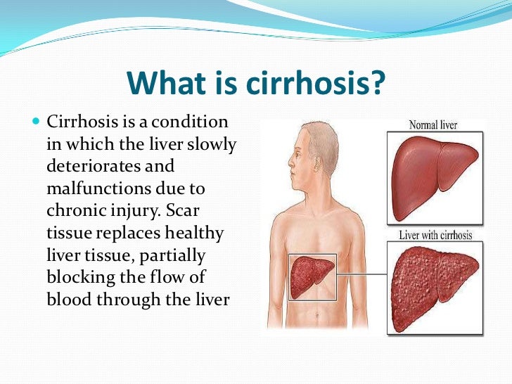 cirrhosis of the liver 1