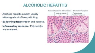 ALCOHOLIC HEPATITIS
• Alcoholic hepatitis acutely, usually
following a bout of heavy drinking.
• Ballooning degeneration and necrosis.
• Inflammatory response: Polymorphs
and scattered.
 