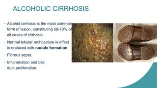 ALCOHOLIC CIRRHOSIS
• Alcohol cirrhosis is the most common
form of lesion, constituting 60-70% of
all cases of cirrhosis.
• Normal lobular architecture is effect
is replaced with nodule formation.
• Fibrous septa.
• Inflammation and bile
duct proliferation.
 