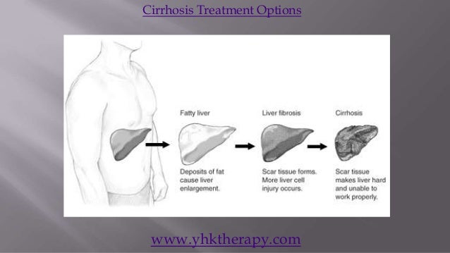 What are some treatment options for cirrhosis?