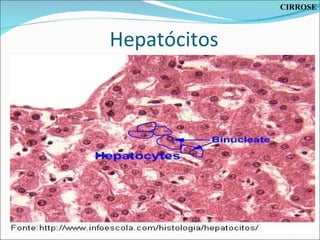 Hepatócitos CIRROSE 