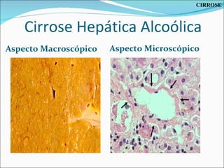 Cirrose Hepática Alcoólica Aspecto Macroscópico  Aspecto Microscópico CIRROSE 