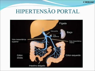 HIPERTENSÃO PORTAL Fígado Baço Veia porta Veia mesentérica inferior Cólon esquerdo Intestino delgado Cólon direito Veia mesentérica superior Veia  esplênica CIRROSE 