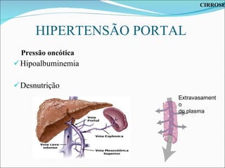 HIPERTENSÃO PORTAL Pressão oncótica Hipoalbuminemia Desnutrição Extravasamento  do plasma CIRROSE 