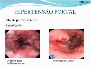 HIPERTENSÃO PORTAL Complicações: Colaterais gastro-esofágicas(varizes) Hemorragia das varizes Shunts portossistêmicos CIRROSE 