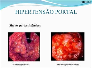 HIPERTENSÃO PORTAL Varizes gástricas Hemorragia das varizes Shunts portossistêmicos CIRROSE 