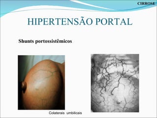 HIPERTENSÃO PORTAL Colaterais  umbilicais Shunts portossistêmicos CIRROSE 