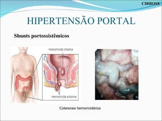 HIPERTENSÃO PORTAL Colarerais hemorroidários Shunts portossistêmicos CIRROSE 