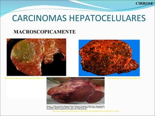 CARCINOMAS HEPATOCELULARES http://pathwiki.pbworks.com/w/page/14673982/GITSlide33 http://www.scielo.org.pe/scielo.php?pid=S1022-51292008000100011&script=sci_arttext http://radiology.uchc.edu/eAtlas/GI/763.htm MACROSCOPICAMENTE CIRROSE 