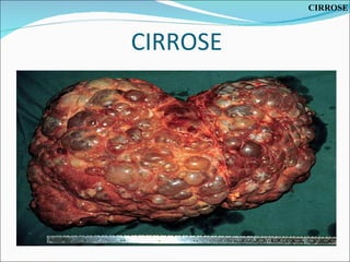Cirrose