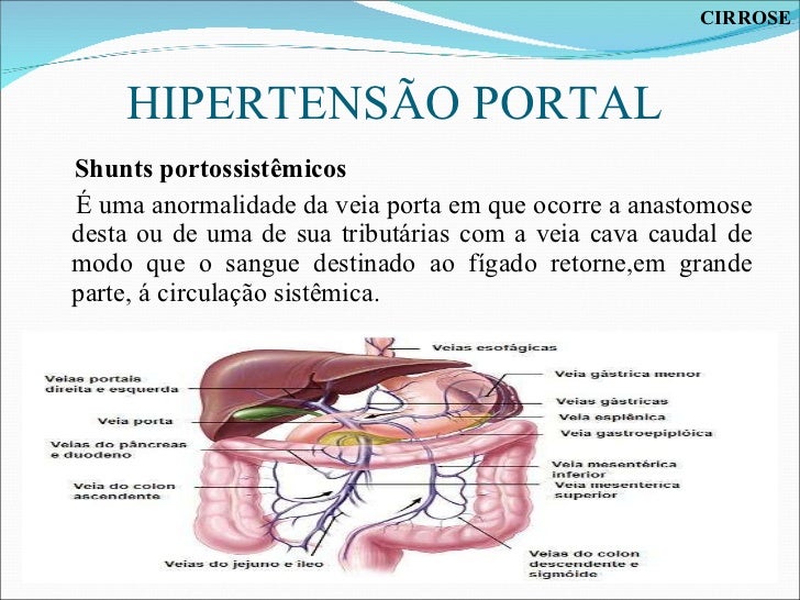 O Que É Hipertensão Portal _ ResuMED de Hipertensão Portal: etiologias ...