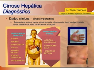 Cirrose Hepática Diagnóstico Dados clínicos –  sinais importantes Telangectazia, eritema palmar, atrofia testicular, ginecomastia, baço palpável, ictericia, ascite, palpação de borda hepática firme e irregular. 