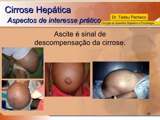 Cirrose Hepática   Aspectos de interesse prático  Ascite é sinal de descompensação da cirrose. 