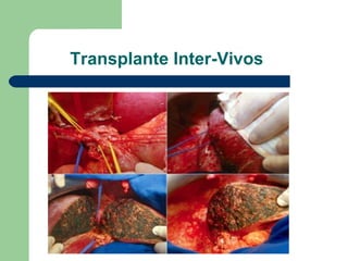 Transplante Inter-Vivos 
