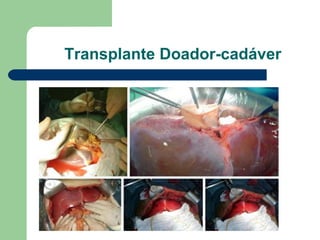 Transplante Doador-cadáver 