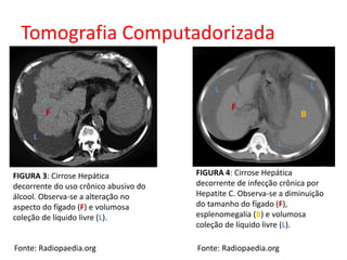 Tomografia Computadorizada 
L L 
L 
FIGURA 4: Cirrose Hepática 
decorrente de infecção crônica por 
Hepatite C. Observa-se a diminuição 
do tamanho do fígado (F), 
esplenomegalia (B) e volumosa 
coleção de líquido livre (L). 
Fonte: Radiopaedia.org 
B 
F 
F 
L 
FIGURA 3: Cirrose Hepática 
decorrente do uso crônico abusivo do 
álcool. Observa-se a alteração no 
aspecto do fígado (F) e volumosa 
coleção de líquido livre (L). 
Fonte: Radiopaedia.org 
 