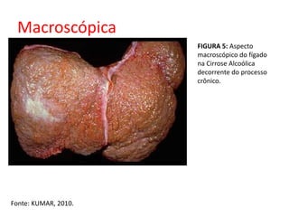 Macroscópica 
Fonte: KUMAR, 2010. 
FIGURA 5: Aspecto 
macroscópico do fígado 
na Cirrose Alcoólica 
decorrente do processo 
crônico. 
 