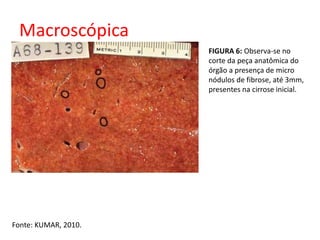 Macroscópica 
Fonte: KUMAR, 2010. 
FIGURA 6: Observa-se no 
corte da peça anatômica do 
órgão a presença de micro 
nódulos de fibrose, até 3mm, 
presentes na cirrose inicial. 
 