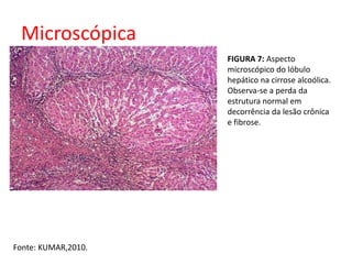 Microscópica 
Fonte: KUMAR,2010. 
FIGURA 7: Aspecto 
microscópico do lóbulo 
hepático na cirrose alcoólica. 
Observa-se a perda da 
estrutura normal em 
decorrência da lesão crônica 
e fibrose. 
 