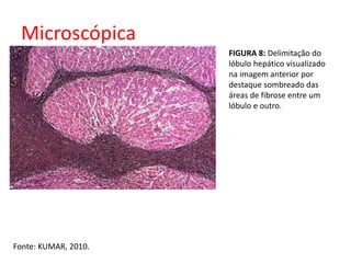 Microscópica 
Fonte: KUMAR, 2010. 
FIGURA 8: Delimitação do 
lóbulo hepático visualizado 
na imagem anterior por 
destaque sombreado das 
áreas de fibrose entre um 
lóbulo e outro. 
 