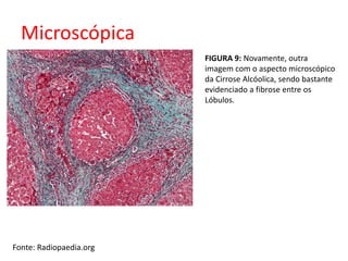 Microscópica 
Fonte: Radiopaedia.org 
FIGURA 9: Novamente, outra 
imagem com o aspecto microscópico 
da Cirrose Alcóolica, sendo bastante 
evidenciado a fibrose entre os 
Lóbulos. 
 