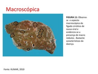 Macroscópica 
Fonte: KUMAR, 2010 
FIGURA 11: Observa-se 
o aspecto 
macroscópico do 
fígado cirrótico de 
causa viral e 
evidencia-se a 
presença de macro 
nódulos . Bastante 
característicos da 
doença. 
 