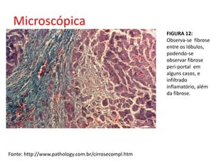 Microscópica 
FIGURA 12: 
Observa-se fibrose 
entre os lóbulos, 
podendo-se 
observar fibrose 
peri-portal em 
alguns casos, e 
infiltrado 
inflamatório, além 
da fibrose. 
Fonte: http://www.pathology.com.br/cirrosecompl.htm 
 