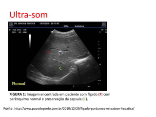 Ultra-som 
C 
F 
FIGURA 1: Imagem encontrada em paciente com fígado (F) com 
parênquima normal e preservação da capsula (C). 
Fonte: http://www.papodegordo.com.br/2010/12/29/figado-gorduroso-esteatose-hepatica/ 
 