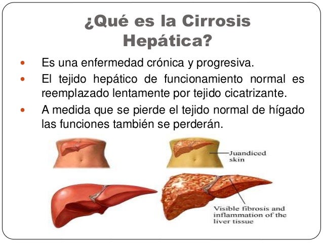 Cirrosis