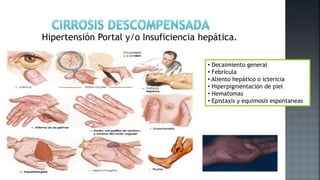Hipertensión Portal y/o Insuficiencia hepática.
• Decaimiento general
• Febrícula
• Aliento hepático o ictericia
• Hiperpigmentación de piel
• Hematomas
• Epistaxis y equimosis espontaneas
 