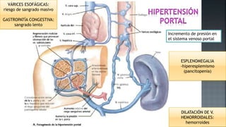 Incremento de presión en
el sistema venoso portal
VÁRICES ESOFÁGICAS:
riesgo de sangrado masivo
GASTROPATÍA CONGESTIVA:
sangrado lento
ESPLENOMEGALIA
-hiperesplemismo
(pancitopenia)
DILATACIÓN DE V.
HEMORROIDALES:
hemorroides
 