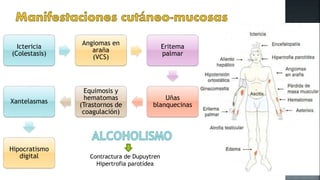 Ictericia
(Colestasis)
Angiomas en
araña
(VCS)
Eritema
palmar
Uñas
blanquecinas
Equimosis y
hematomas
(Trastornos de
coagulación)
Xantelasmas
Hipocratismo
digital Contractura de Dupuytren
Hipertrofia parotídea
 
